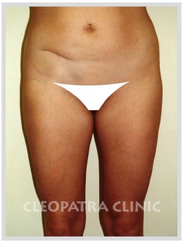 liposuction of abdomen with correction of the scar after the gut