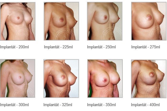 Velikostní tabulka implantátů