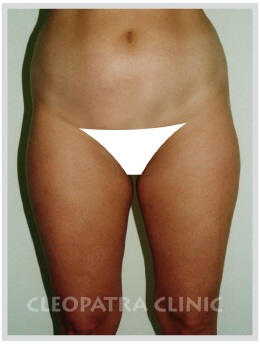 Liposuction - hips - waist and kidneys, thighs - outer and inner, abdomen