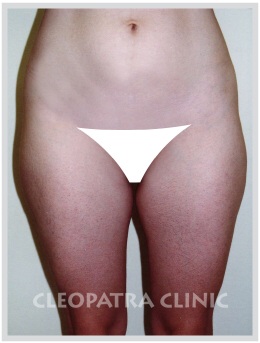 liposuction of hips, external, inner thighs