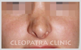 Reoperation after another workplace - the entire nose with an implant - a medpour