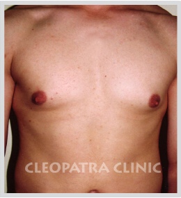 Gynecomastia - reduction - liposuction + surgical removal of the glands