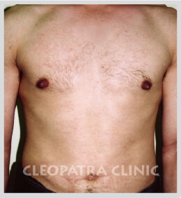 reduction of male breasts by liposuction and removal of enlarged mammary gland - 3 months after the procedure