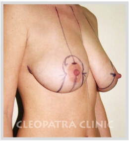 Anheben der abgesenkten Brüste Skizze des chirurgischen Eingriffs