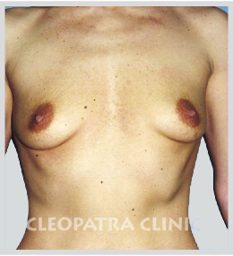 Magnification - round silicone implants under the gland, scar under the breasts