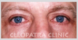 upper and lower eyelid surgery to remove fatty prolapse