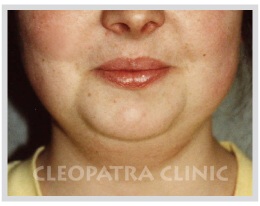 Chin liposuction - fat extraction