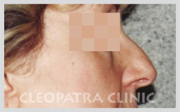 Removal of nose bum, reduction of nose, female 50 years