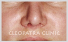 adjustment of the soft part of the nose through the cartilage - 3 months after the procedure