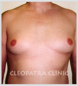 Ginekomastia - redukcja - liposukcja + chirurgiczne usunięcie gruczołów