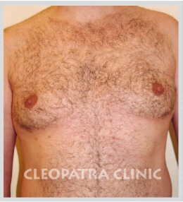 redukcja męskich piersi poprzez liposukcję i usuwanie powiększonego gruczołu sutkowego - 3 miesiące po zabiegu