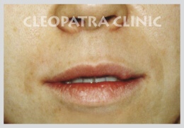 the operative enlargement of the upper lip by the extraction of the mucosa