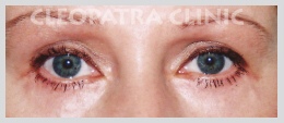 Lower eyelid surgery with removal of fatal prolapse