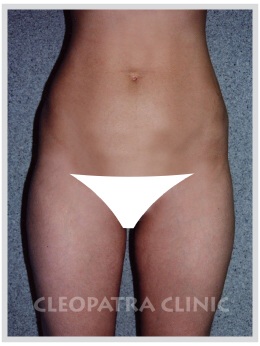 Fettabsaugung der äußeren Oberschenkel und des Bauches