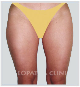 Liposuction of thigh - external and internal
