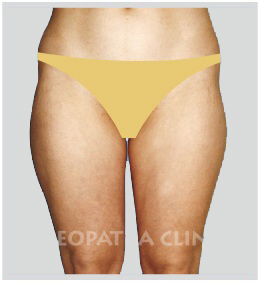 liposuction of the outer and inner thighs