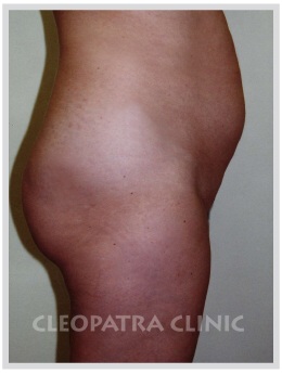 liposuction of the abdomen free - without surgical removal of the skin