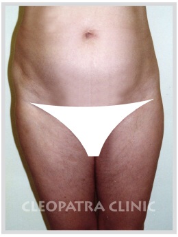 liposuction of the abdomen free - without surgical removal of the skin